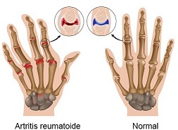 Para qué es el colágeno artitris