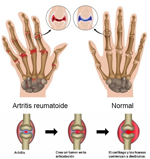 Colágeno para artitris