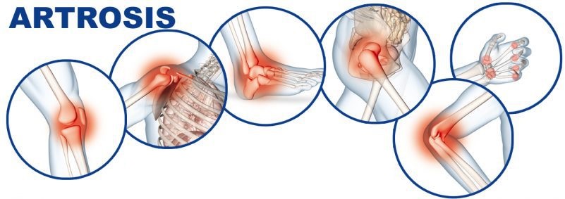 Colágeno o glucosamina para los huesos Qué es mejor colágeno o glucosamina