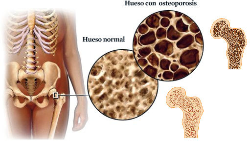 Colágenos contra osteoporosis